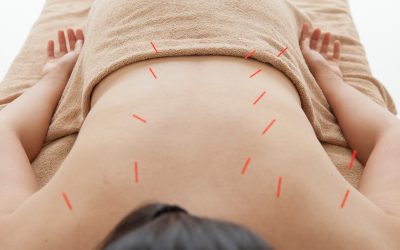 Acupuncture and Anxiety: How Ancient Healing Supports Modern Mental Health